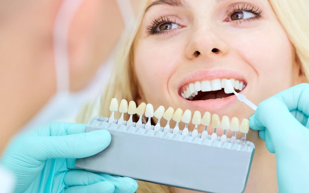 Why Choose Professional Teeth Whitening Over Home Treatments