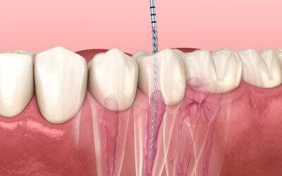 Can Root Canal Treatment Save Your Tooth Life?