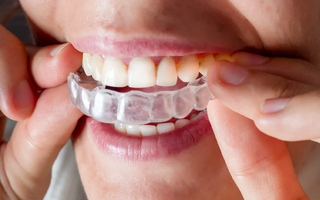 Which One Is Better Invisalign Or Braces?