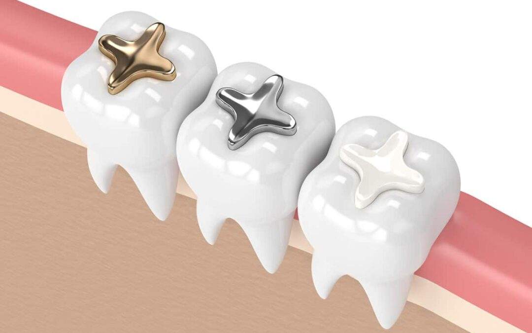 Types of Dental Fillings: Which One Is Right for You?