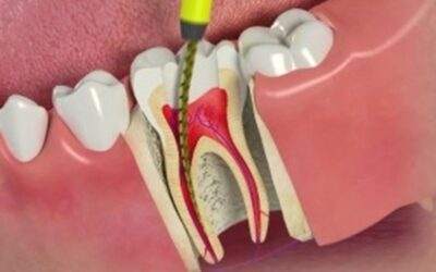 Root Canal Misconceptions