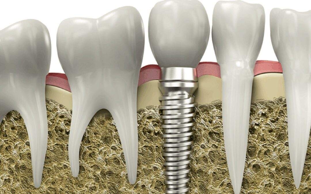 Root Canal Treatment in Rahatni: Is It Painful? Myths vs. Facts