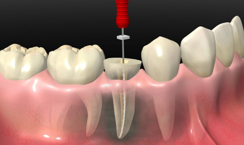 Top 7 Signs You Might Need a Root Canal