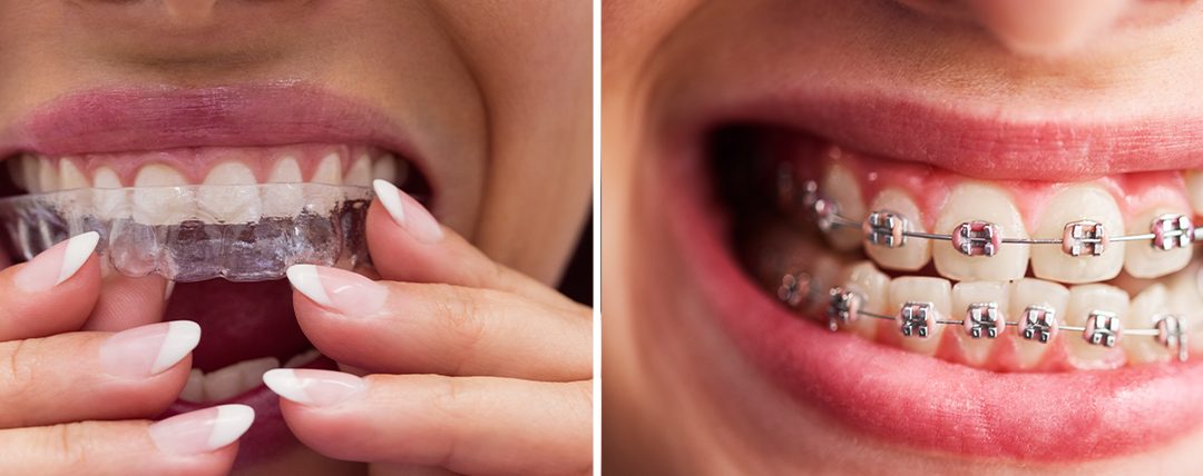 Braces vs. Clear Aligners – Which Is Better for You?
