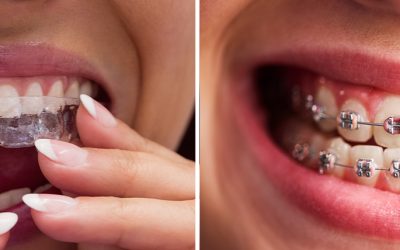 Braces vs. Clear Aligners – Which Is Better for You?