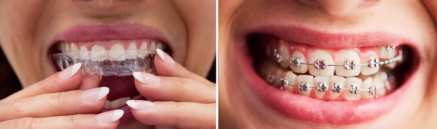 "Braces vs. Clear Aligners – Which Is Better for You?"