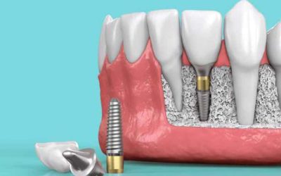 Dental Implants in Wakad: Cost, Procedure & What to Expect