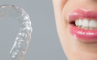 Braces for Adults in Pune – It’s Never Too Late to Straighten Your Smile!