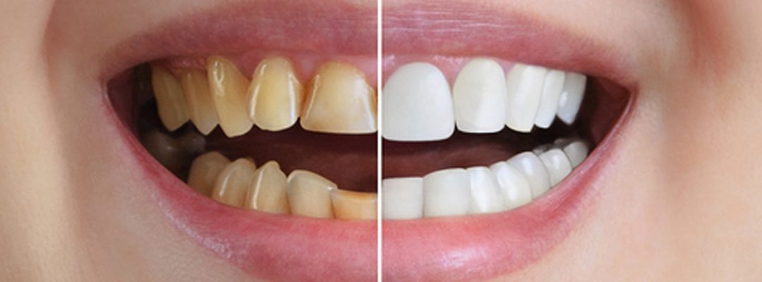 Full Mouth Rehabilitation: What Is It and Who Needs It?