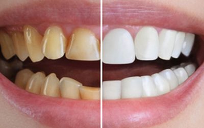 Full Mouth Rehabilitation: What Is It and Who Needs It?