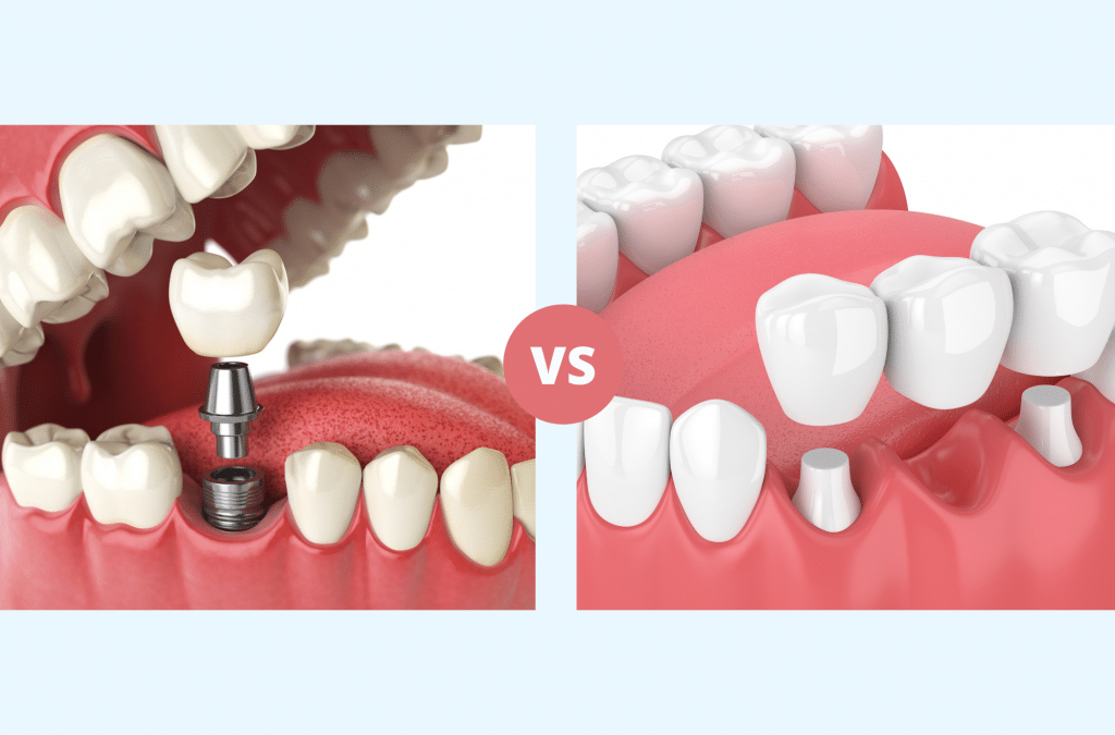 Dental Implants vs. Bridges: Which is Right for You?