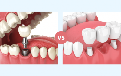 Dental Implants vs. Bridges: Which is Right for You?