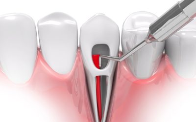 Modern Dental Treatments at Galaxy Clinic: From Painless Root Canals to Smile Design