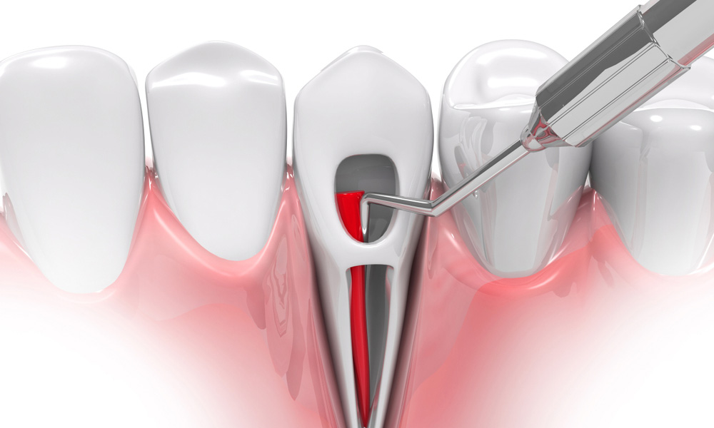 Modern Dental Treatments at Galaxy Clinic: From Painless Root Canals to Smile Design